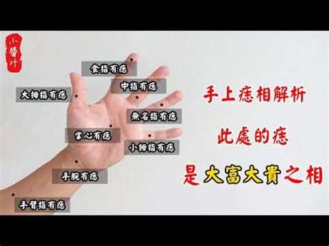 手背上有胎記|胎記位置含義——肚臍、鎖骨、手臂、大腿、背部、胳膊、額頭。